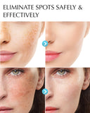 dark-spot-remover-for-face-and-body-hyperpigmentation-treatment-natural-ingredient-melasma-sun-spot-remover